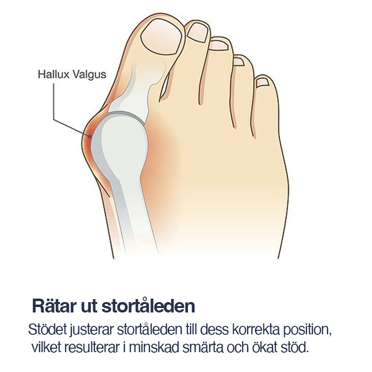 Korrigerende støtte med tåskillere (2 stk.), Hallux Valgus